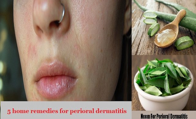 Treatment perioral vinegar dermatitis 10 Natural
